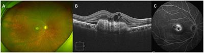 Analysis of factors affecting prognosis of the visual acuity and baseline risk factors for subretinal fibrosis in neovascular age-related macular degeneration patients